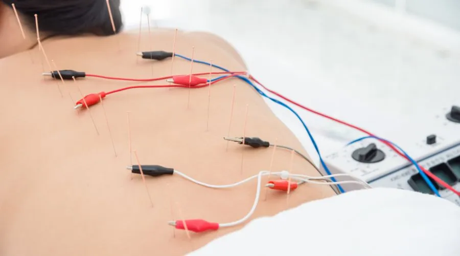 背中に刺した鍼に低周波電極が接続され、電気刺激を与えている様子